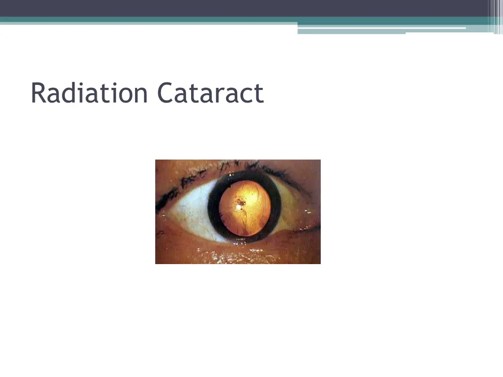 radiation cataract