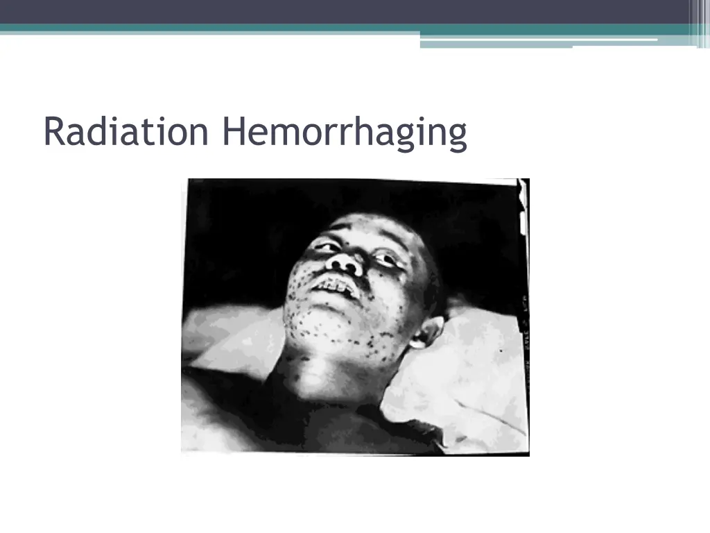 radiation hemorrhaging