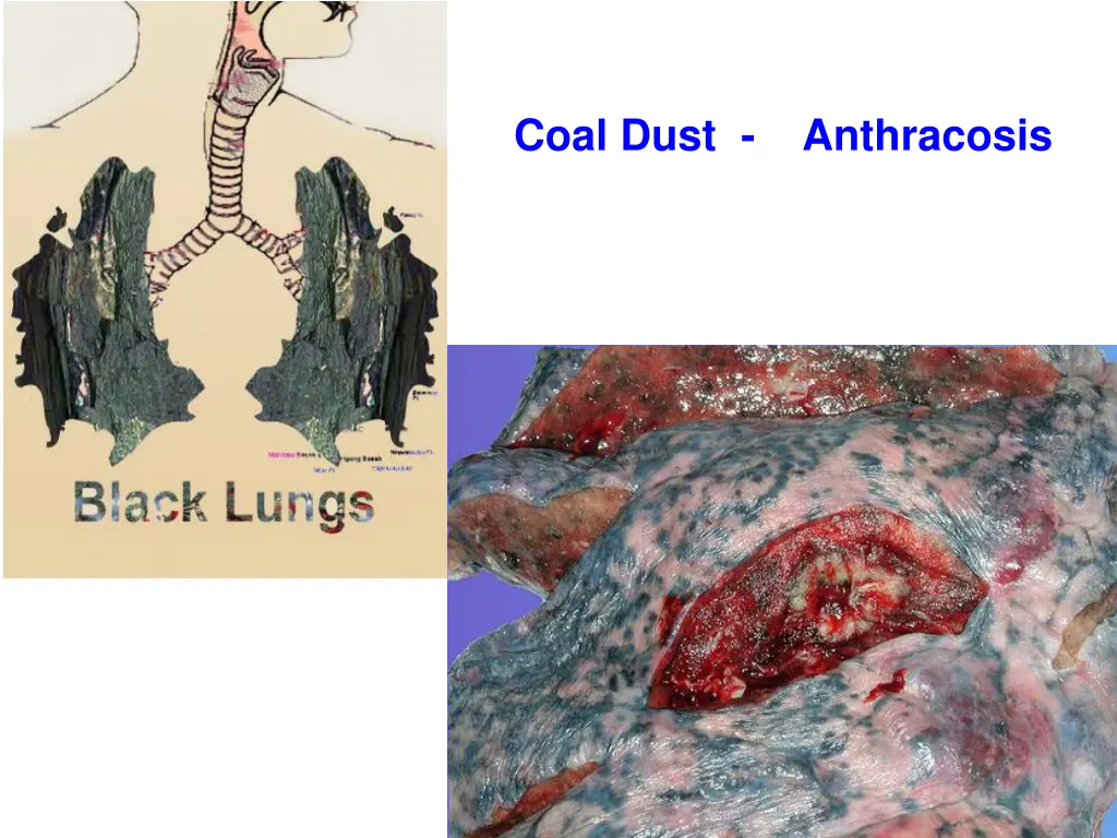 coal dust anthracosis