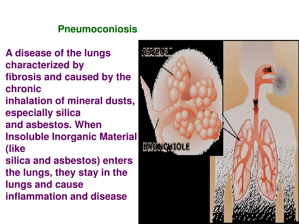 pneumoconiosis