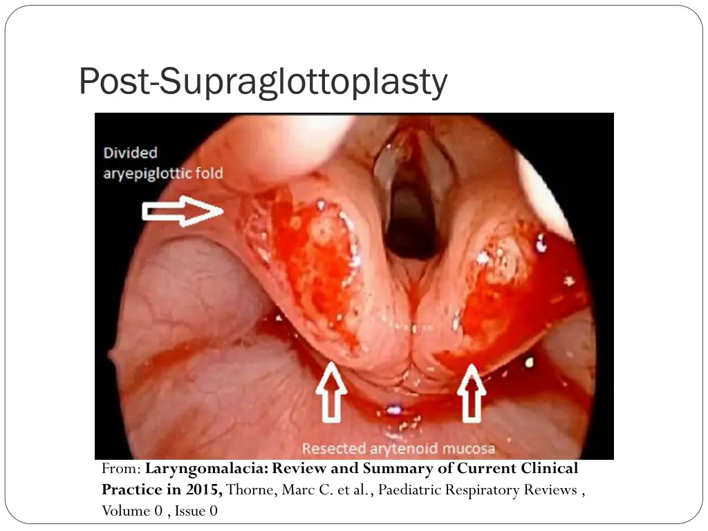 post supraglottoplasty