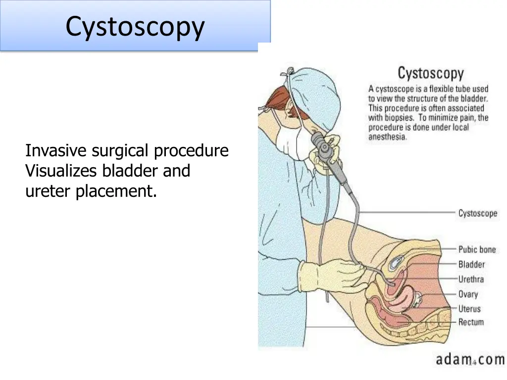 cystoscopy