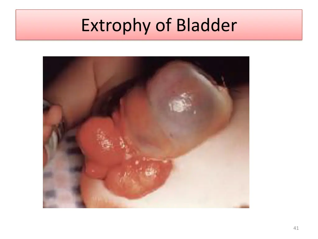 extrophy of bladder 2