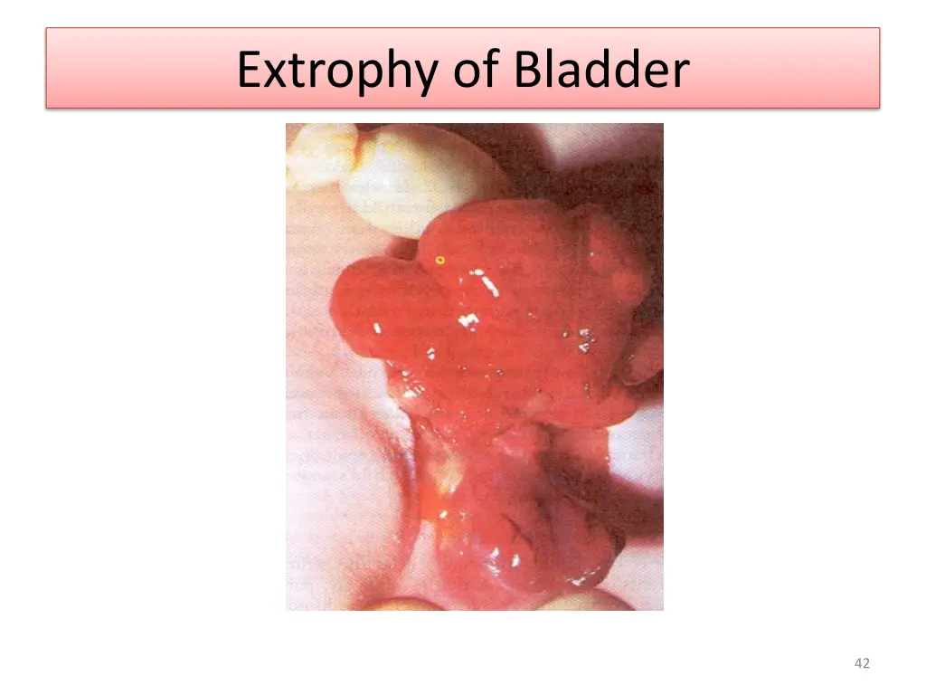 extrophy of bladder 3