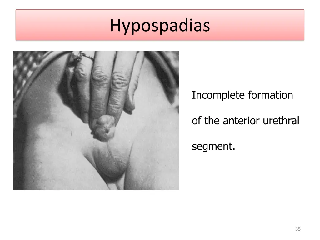 hypospadias