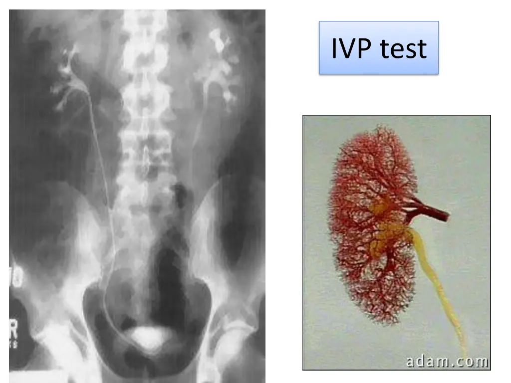 ivp test