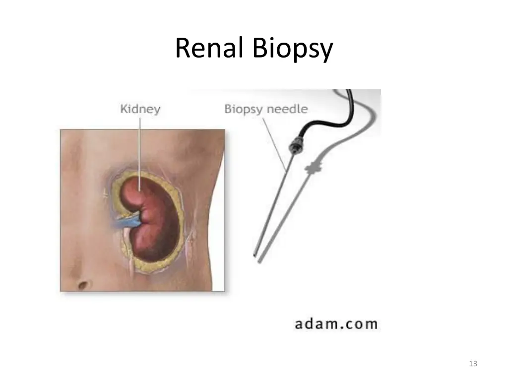 renal biopsy