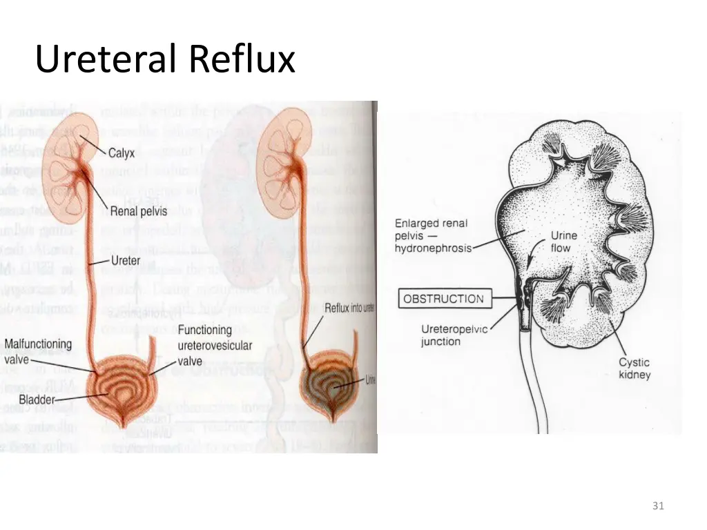 ureteral reflux