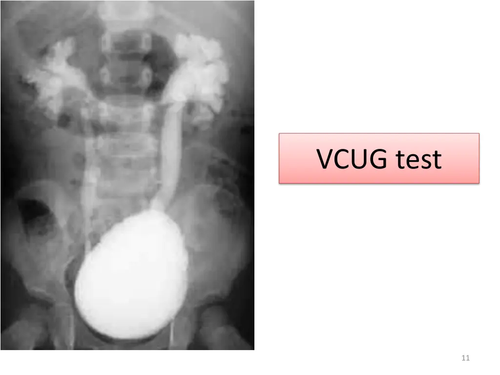 vcug test