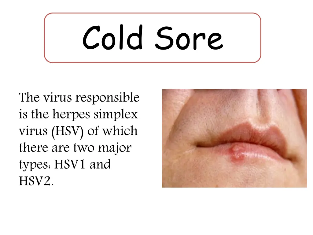 cold sore