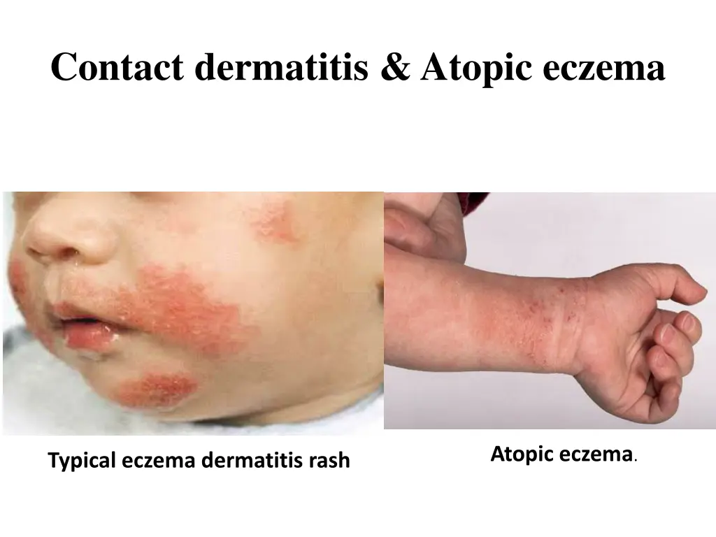 contact dermatitis atopic eczema