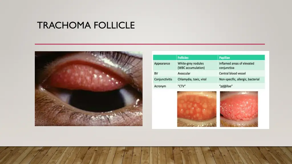 trachoma follicle