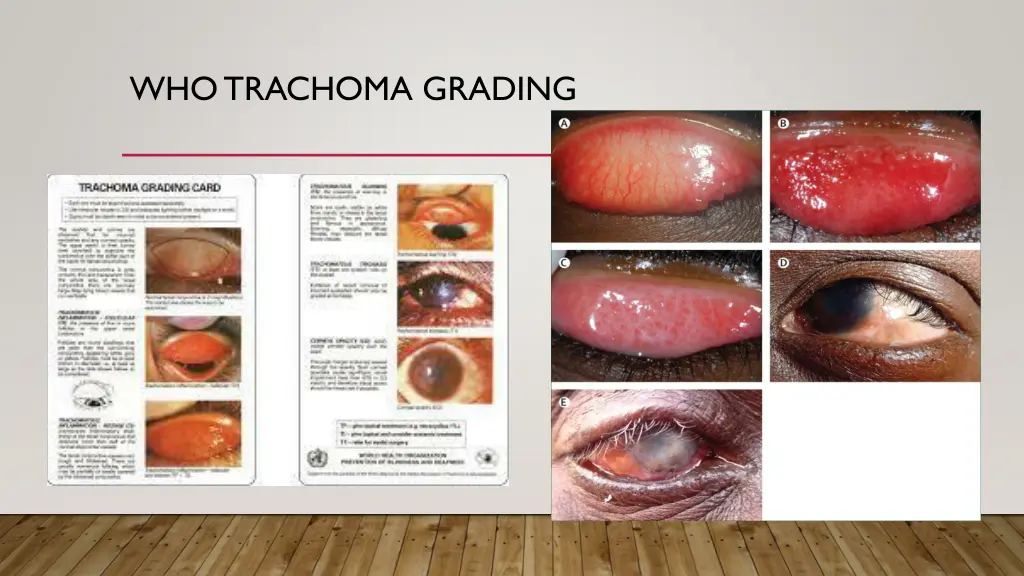 who trachoma grading