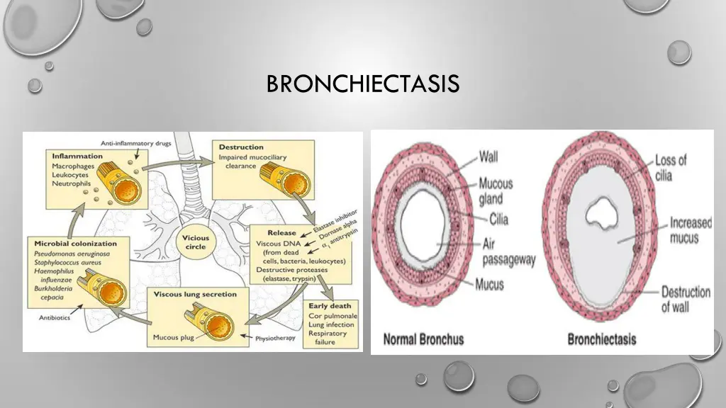 bronchiectasis