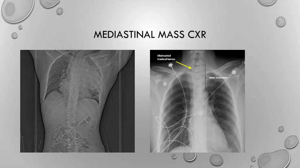 mediastinal mass cxr