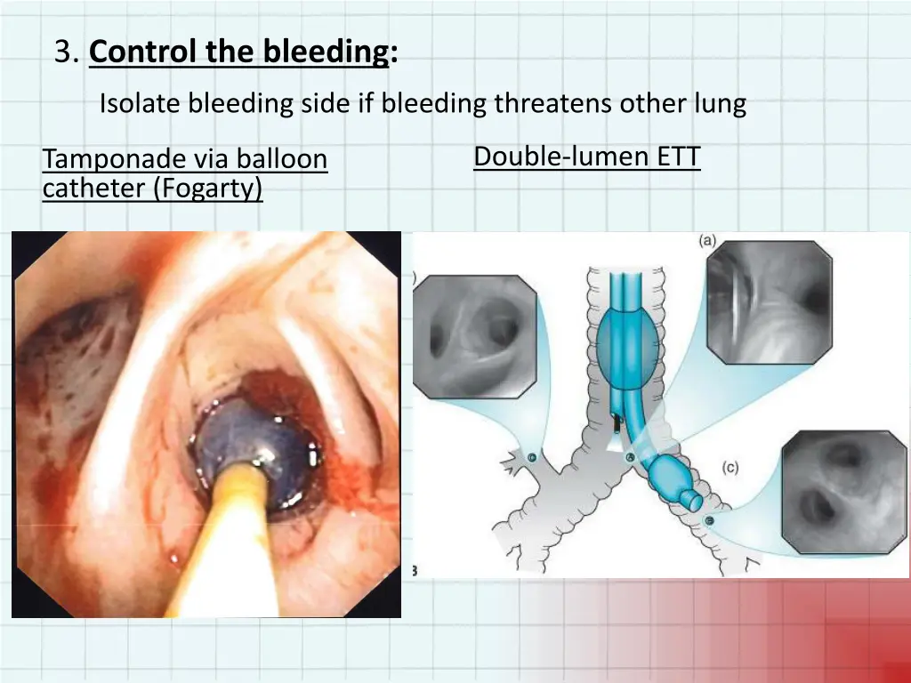 3 control the bleeding