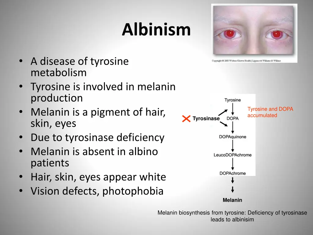 albinism