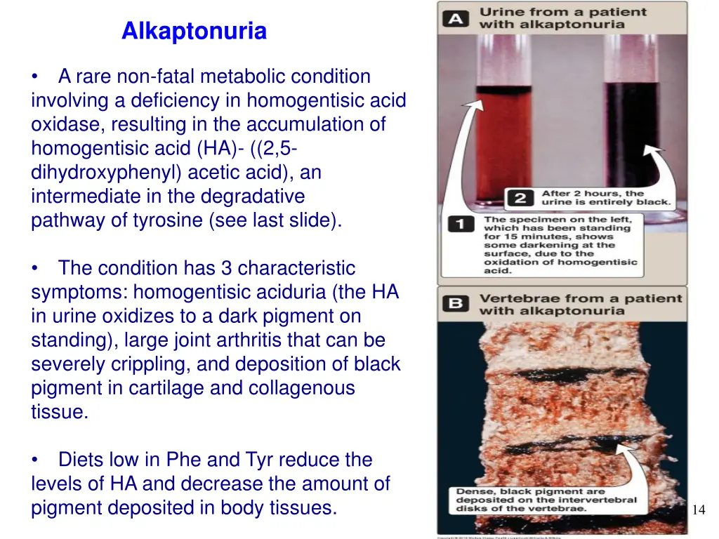 alkaptonuria