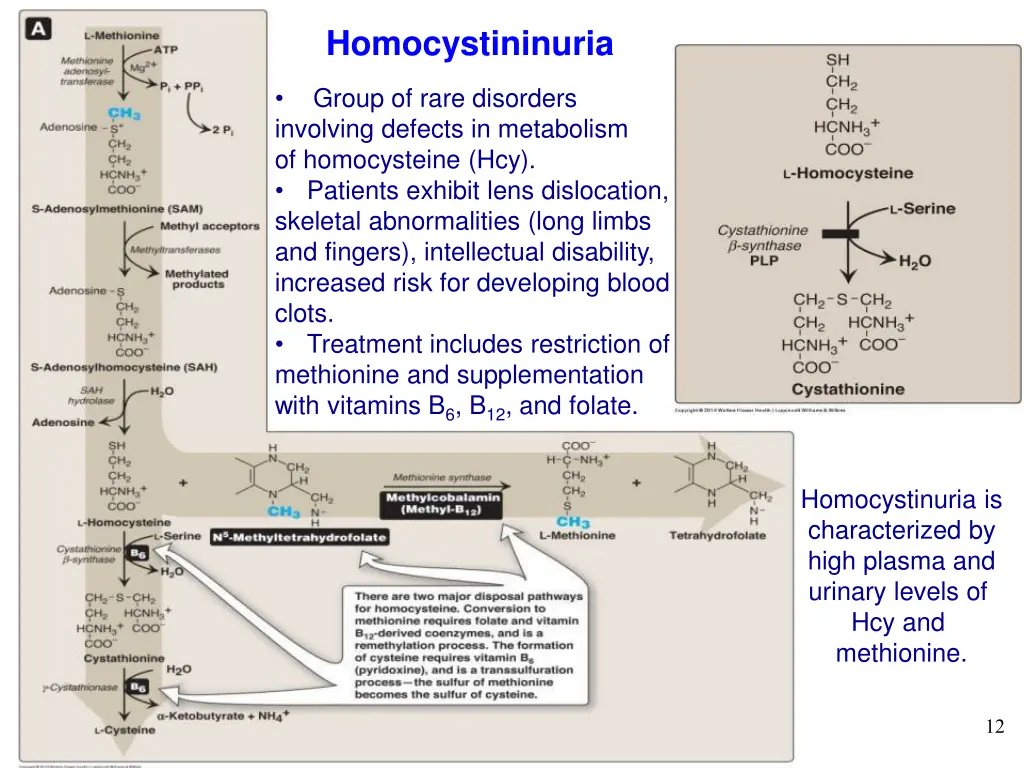 homocystininuria