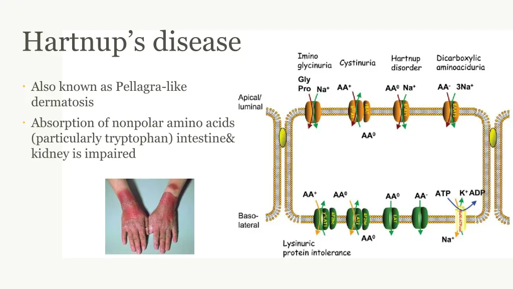 hartnup s disease