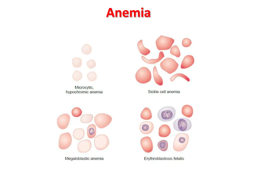 anemia 1