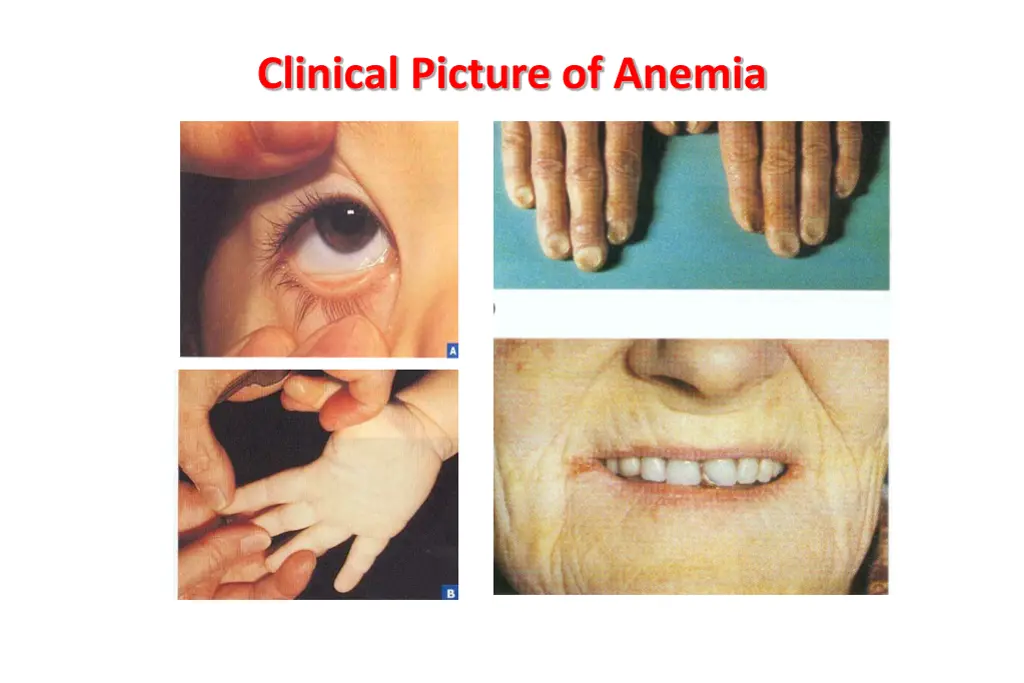 clinical picture of anemia 1