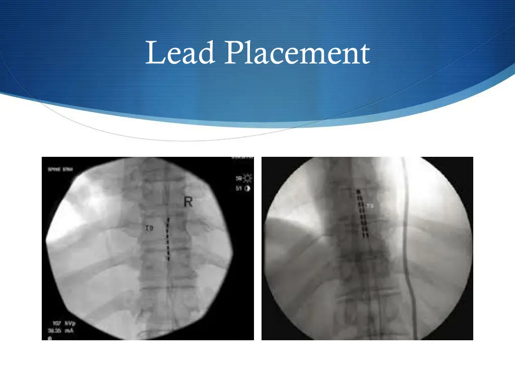 lead placement