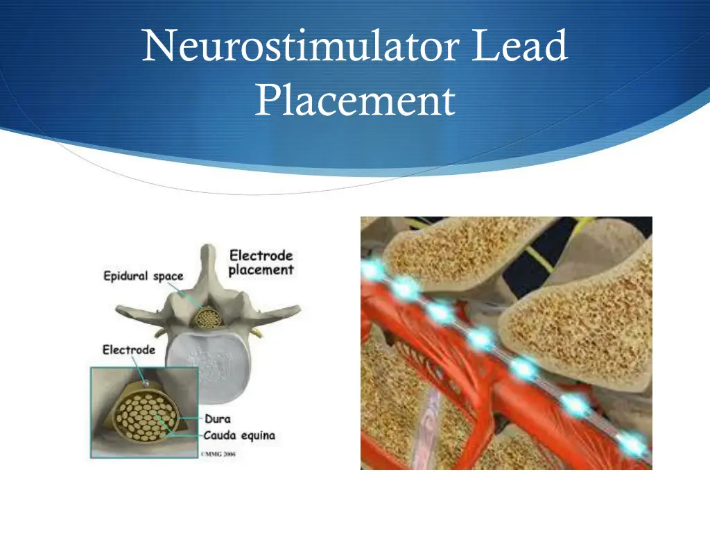 neurostimulator lead placement