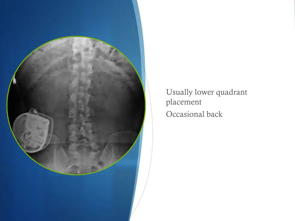 usually lower quadrant placement occasional back