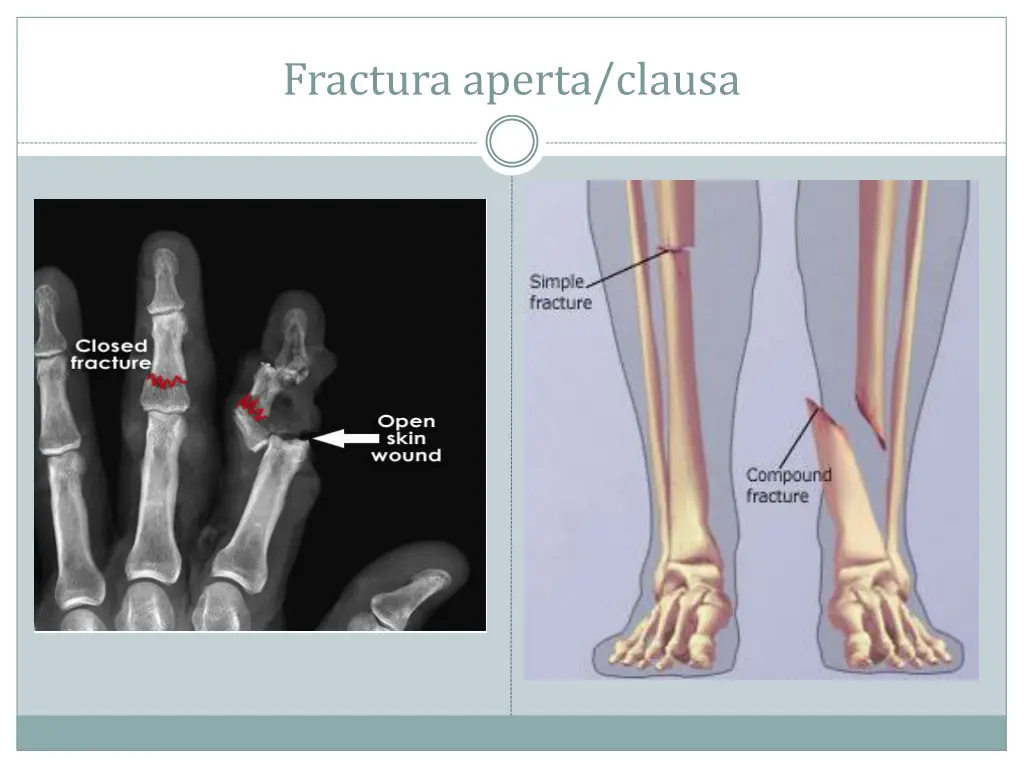 fractura aperta clausa