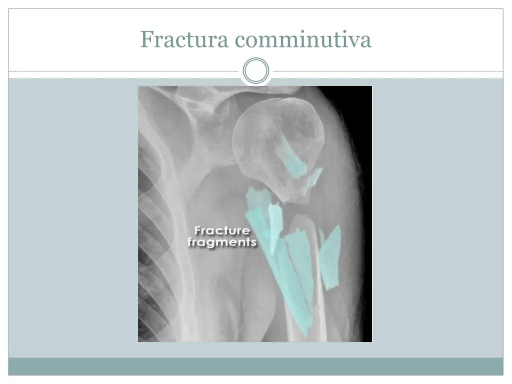 fractura comminutiva