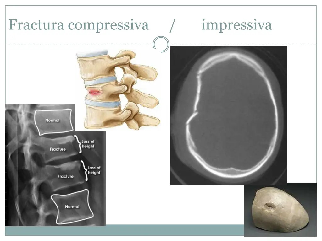 fractura compressiva