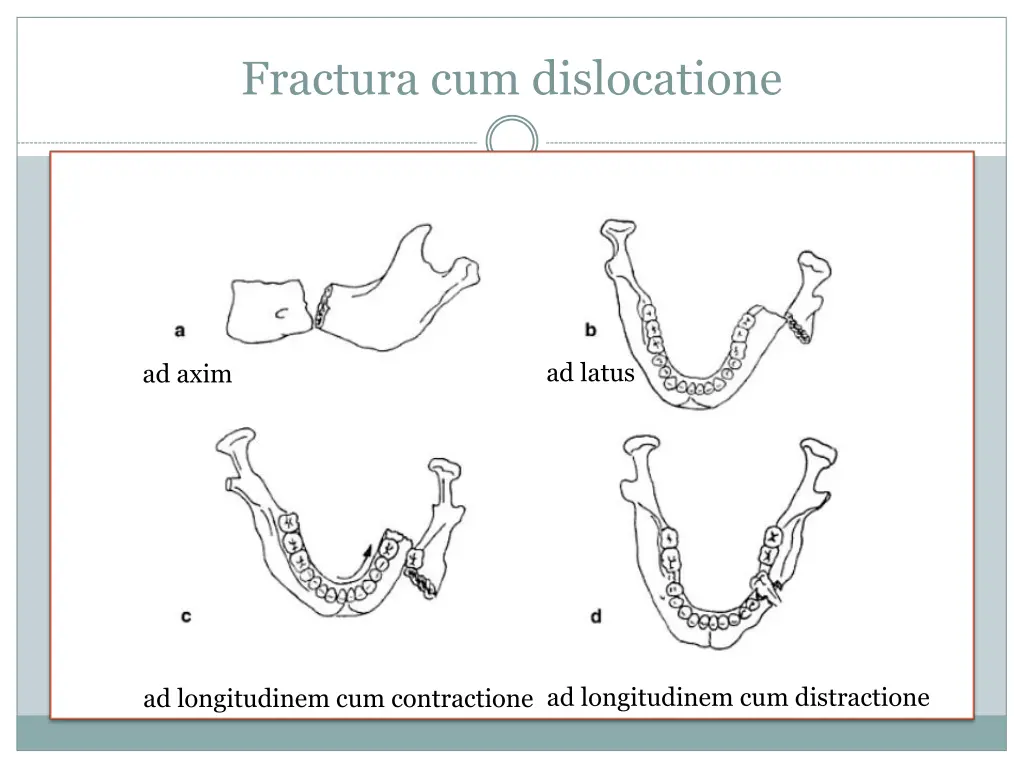 fractura cum dislocatione