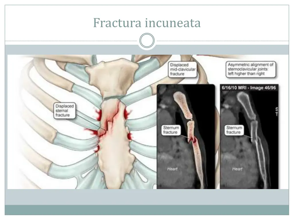 fractura incuneata