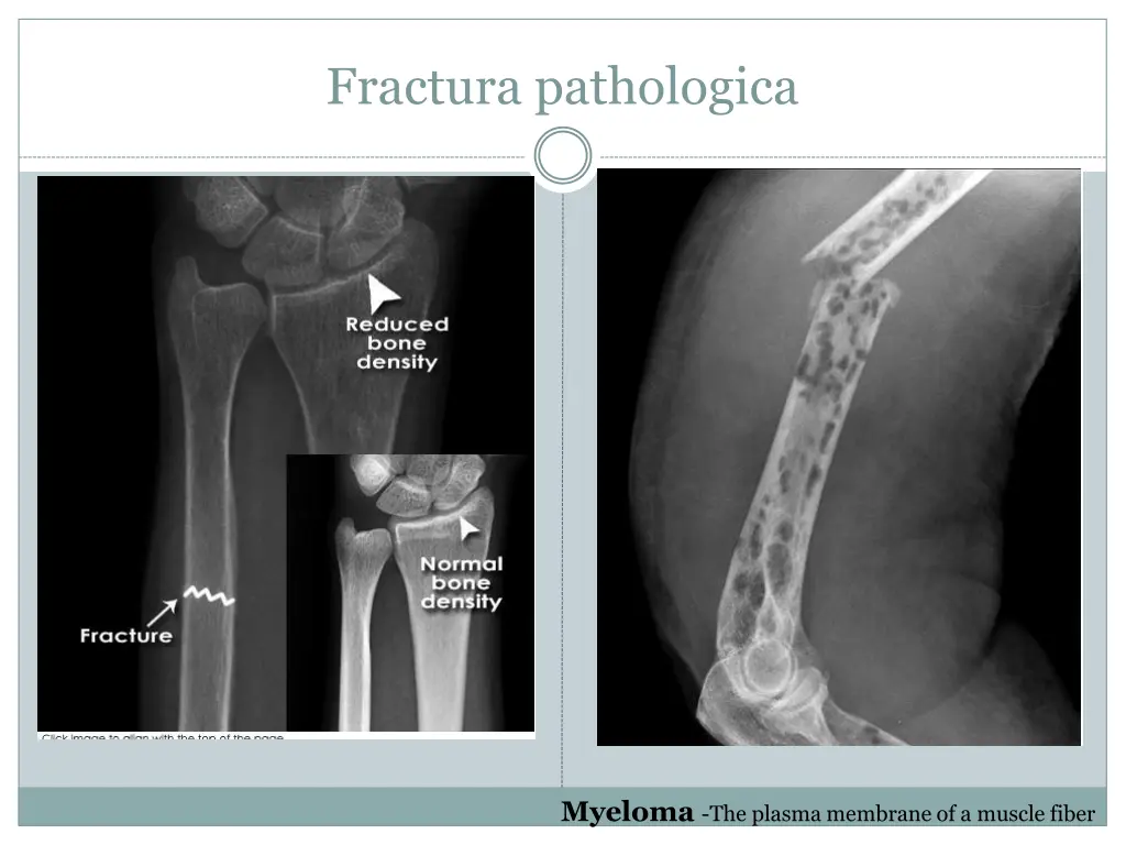 fractura pathologica