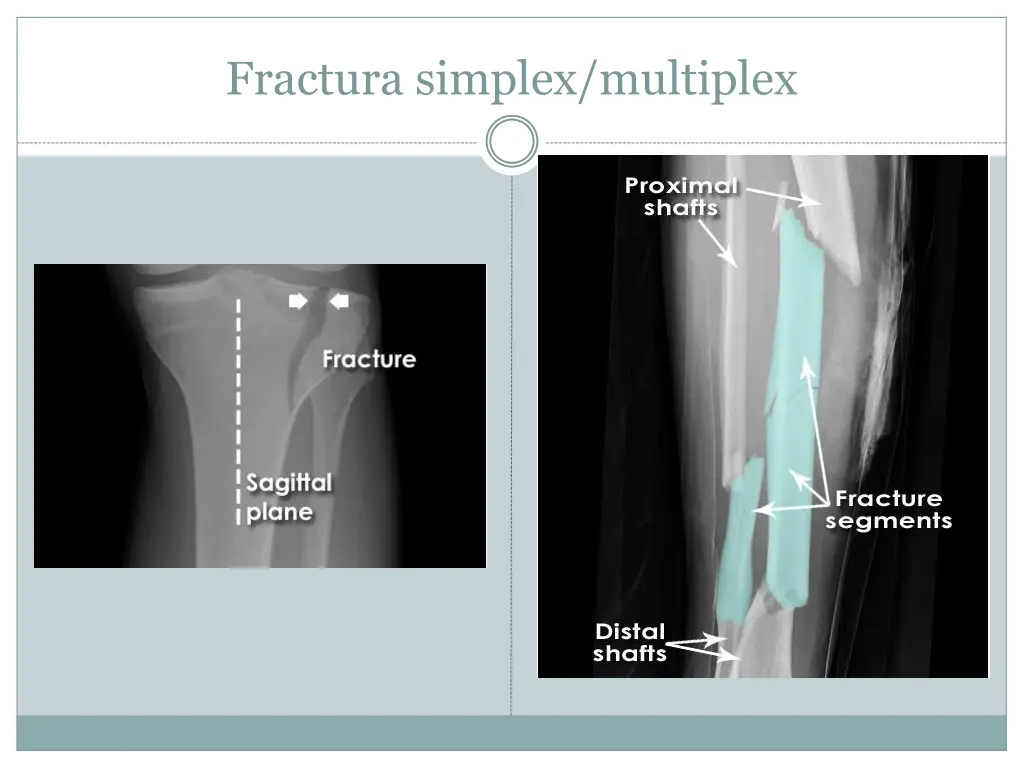 fractura simplex multiplex