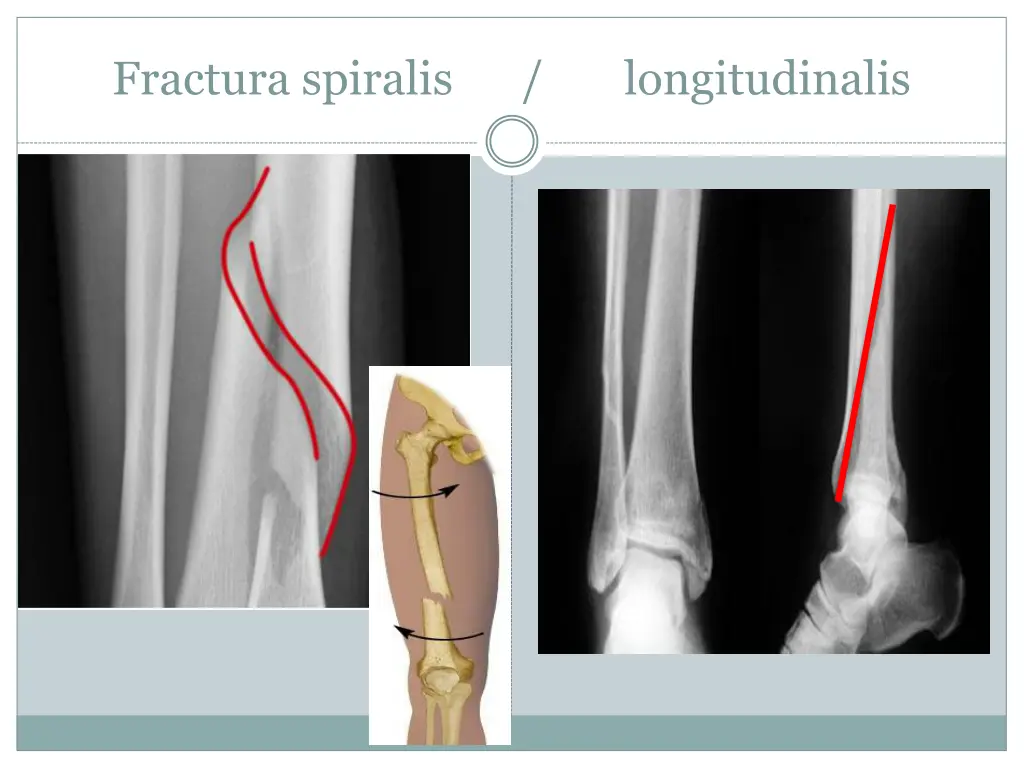 fractura spiralis