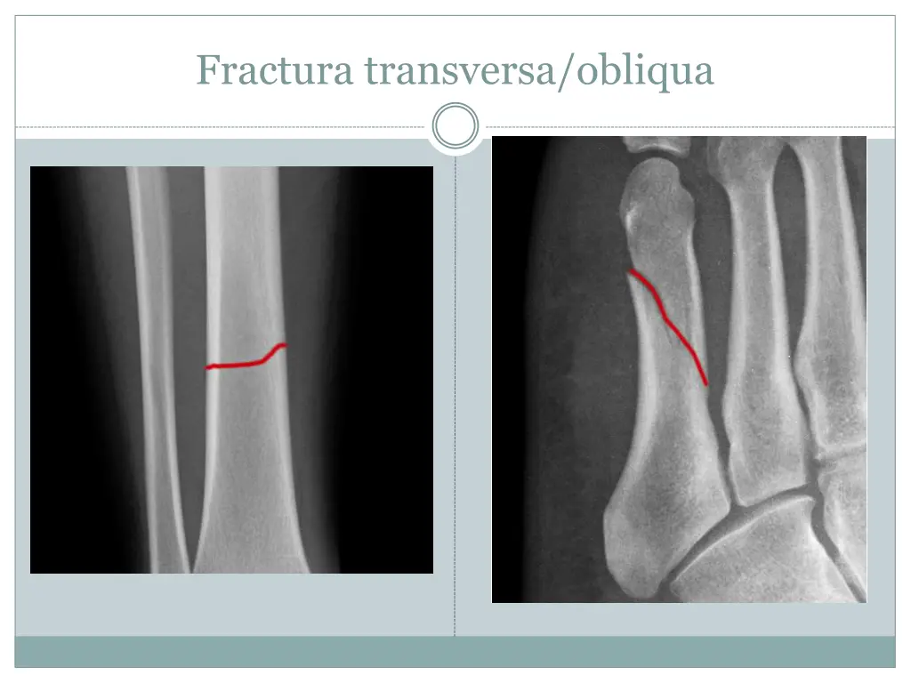 fractura transversa obliqua