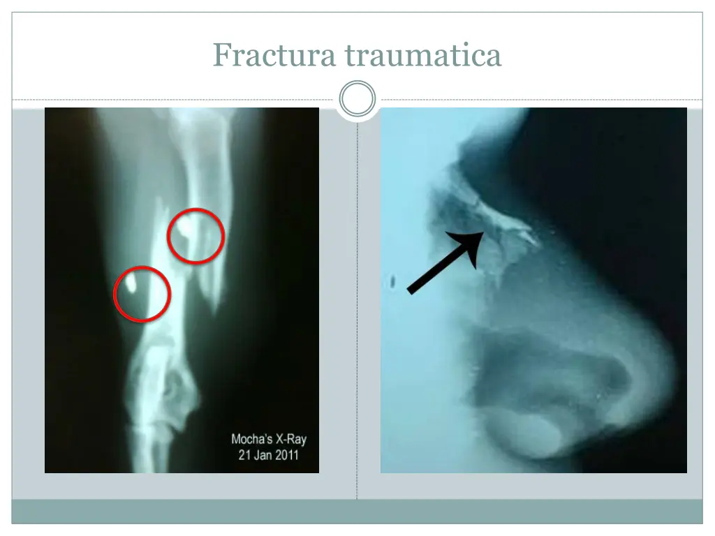 fractura traumatica