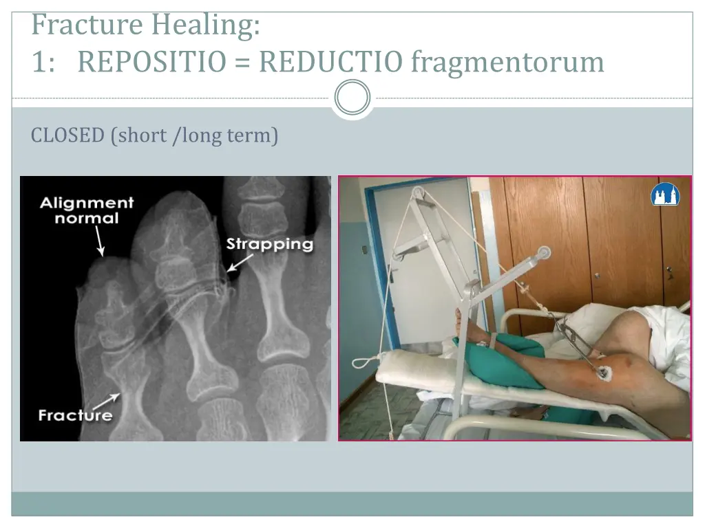 fracture healing 1 repositio reductio fragmentorum