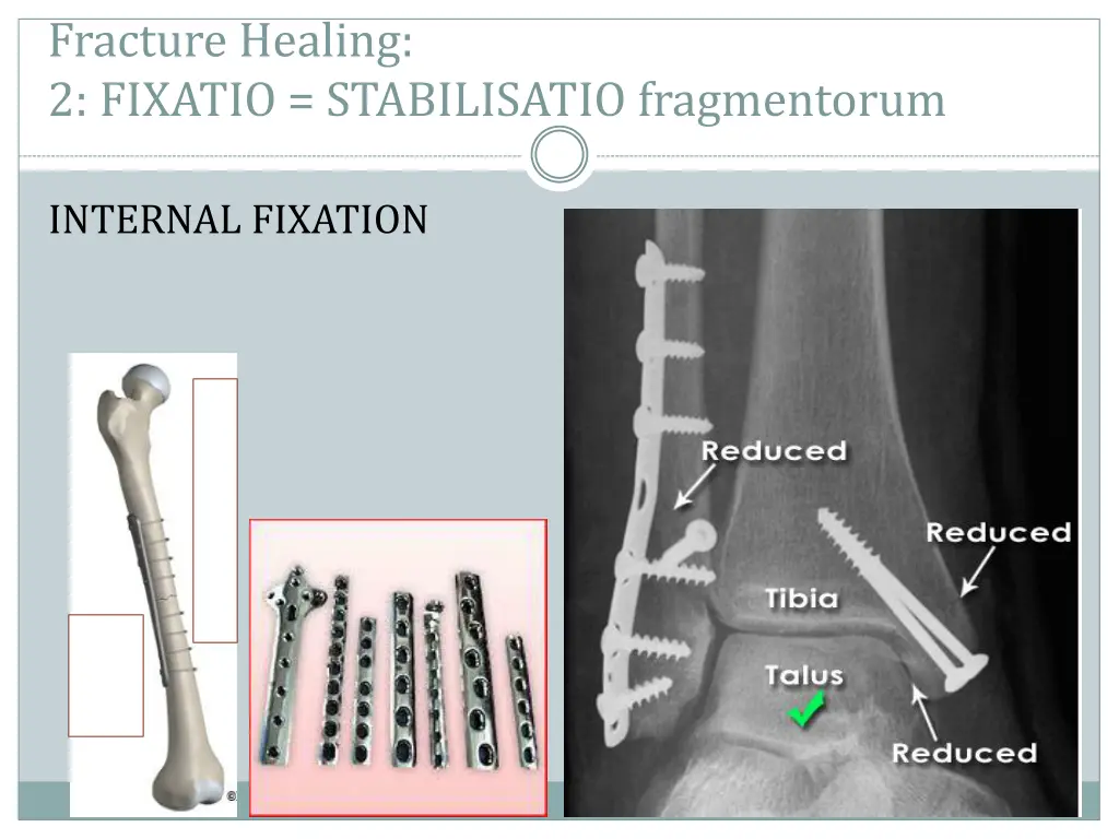 fracture healing 2 fixatio stabilisatio 1