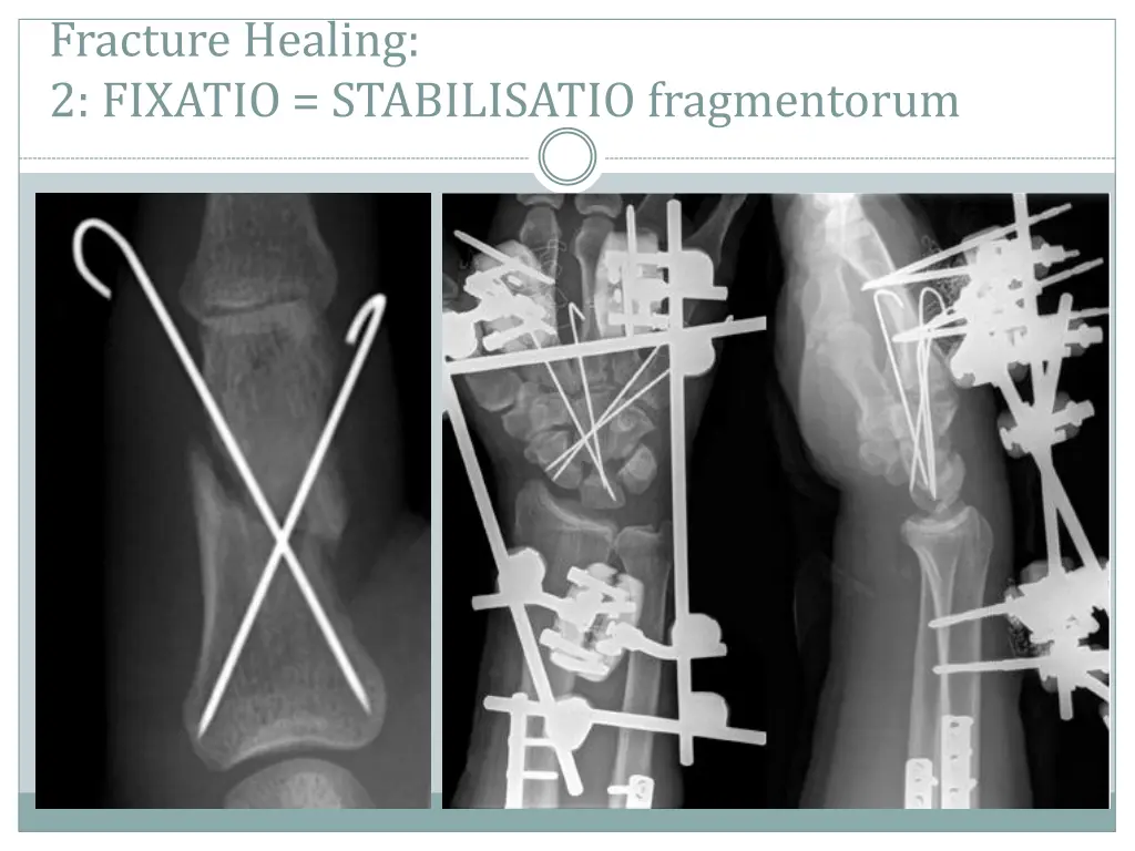 fracture healing 2 fixatio stabilisatio 2