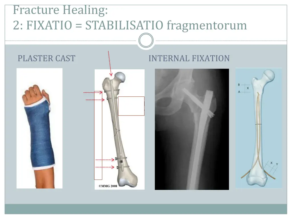 fracture healing 2 fixatio stabilisatio