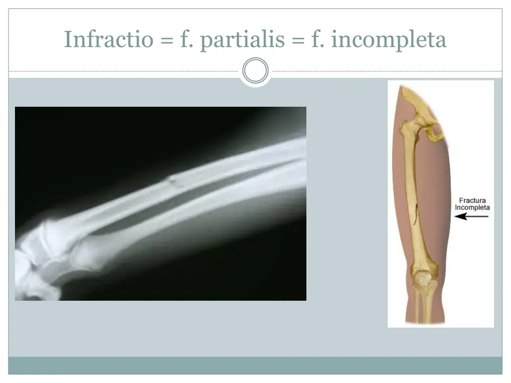 infractio f partialis f incompleta