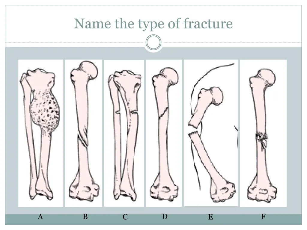 name the type of fracture