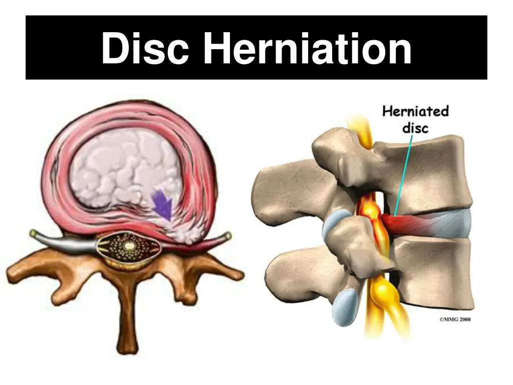 disc herniation