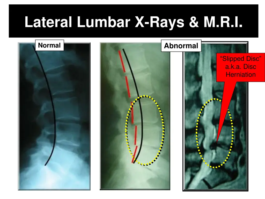 lateral lumbar x rays m r i