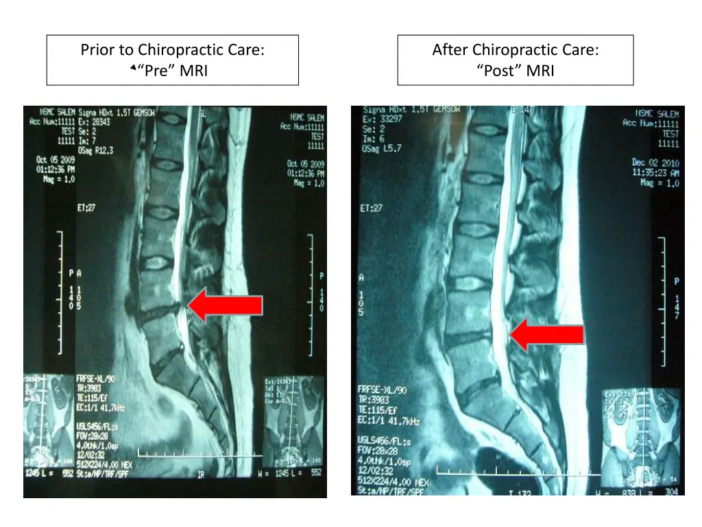 prior to chiropractic care pre mri