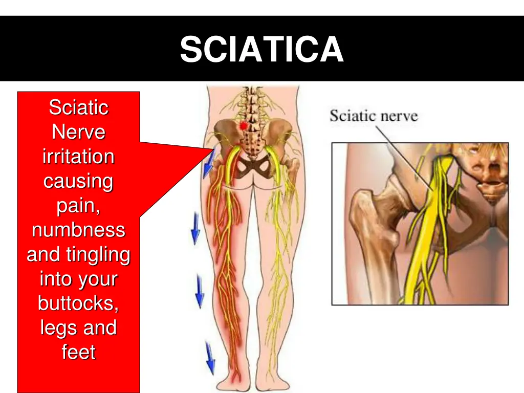 sciatica