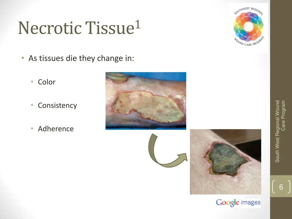 necrotic tissue 1